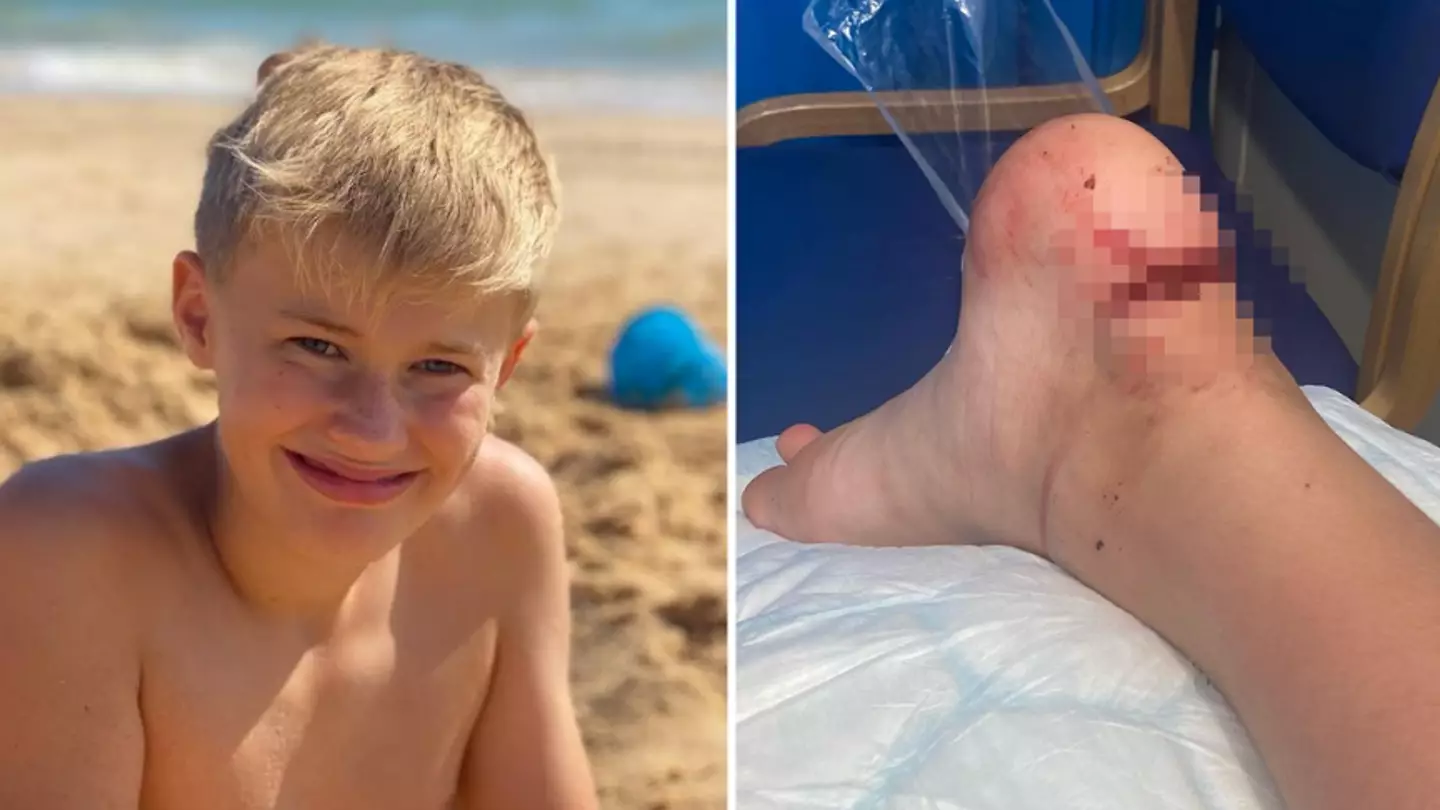 Mum Calls For Disposable BBQs To Be Banned On Beaches After Son Tears Achilles Tendon