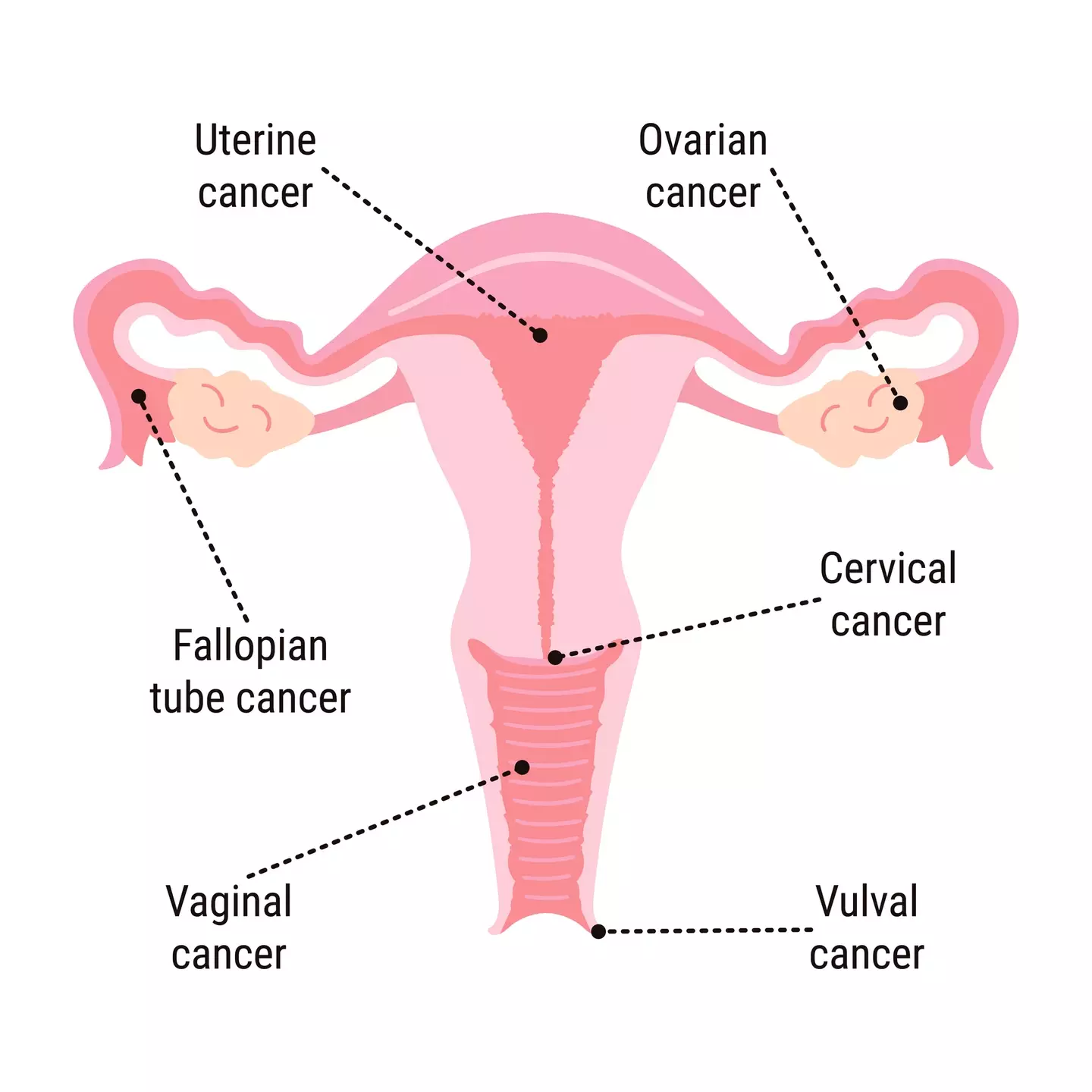 Vaginal cancer occurs when cancer grows in the lining of the vagina and largely affects women over the age of 75 (m.malinika/Getty Images)