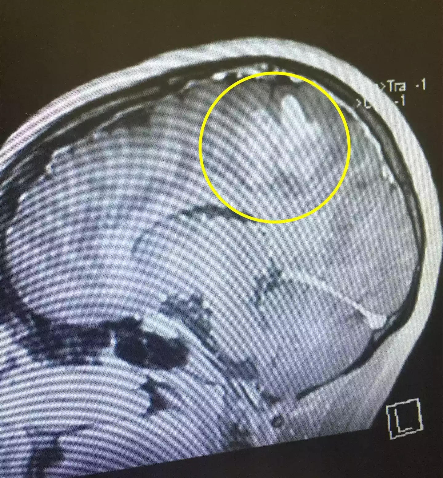 Jade was diagnosed with Grade 4 Glioblastoma - the most aggressive type of cancer which originates in the brain (Kennedy)