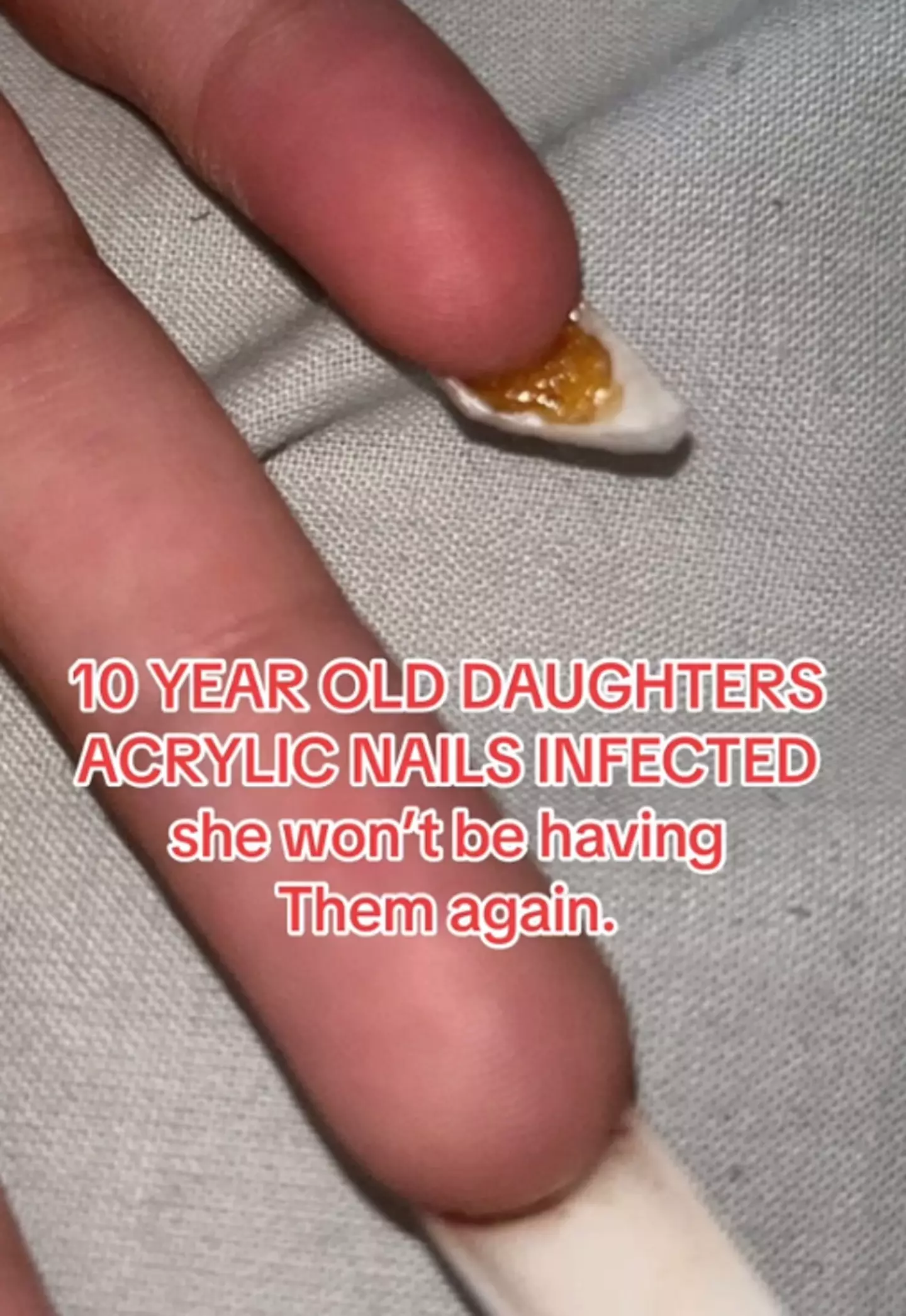 The nails became infected and caused the girl a lot of pain.