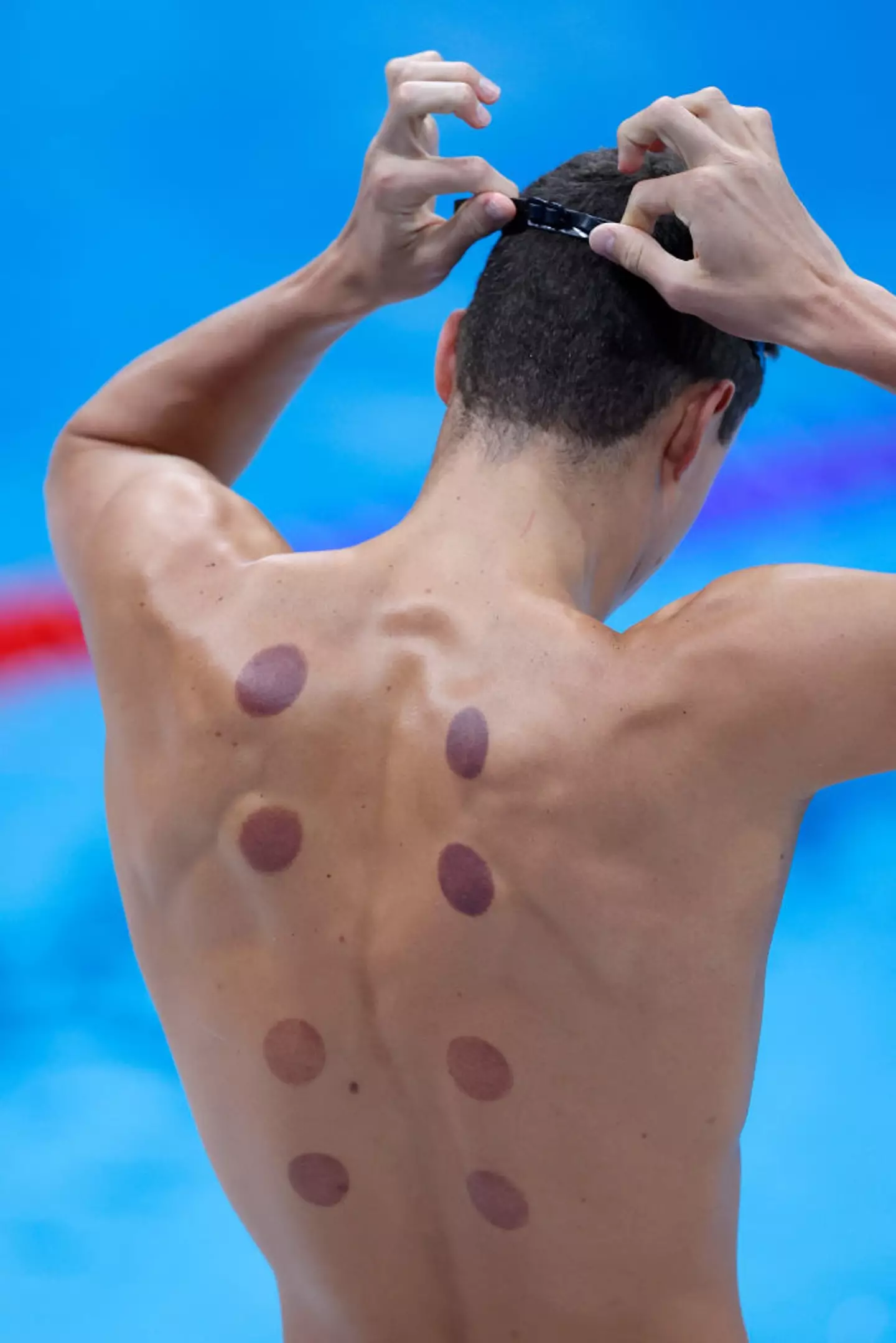 The ancient massage therapy is used as pain relief. (Al Bello / Staff / Getty Images)