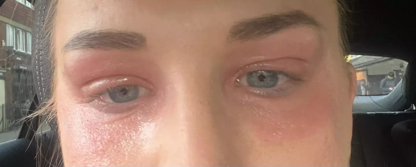 Georgina's eyes were severely affected. (SWNS)