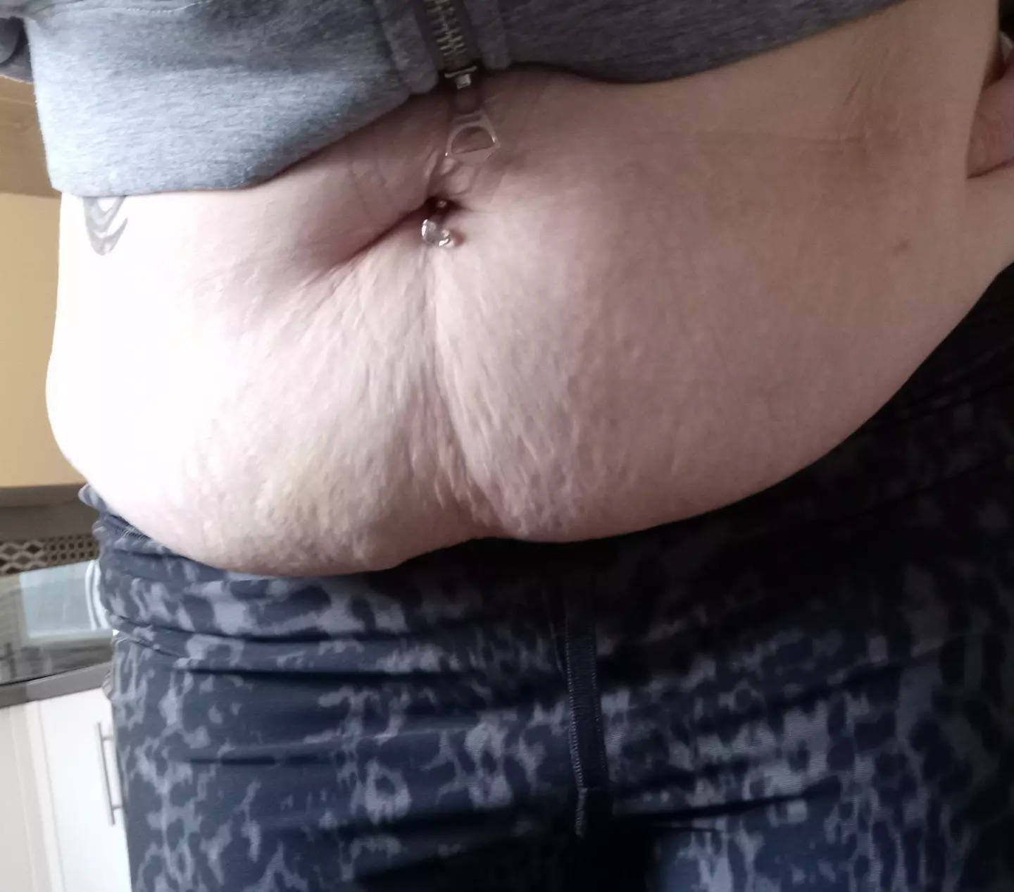 But her loose skin is causing pain (SWNS)