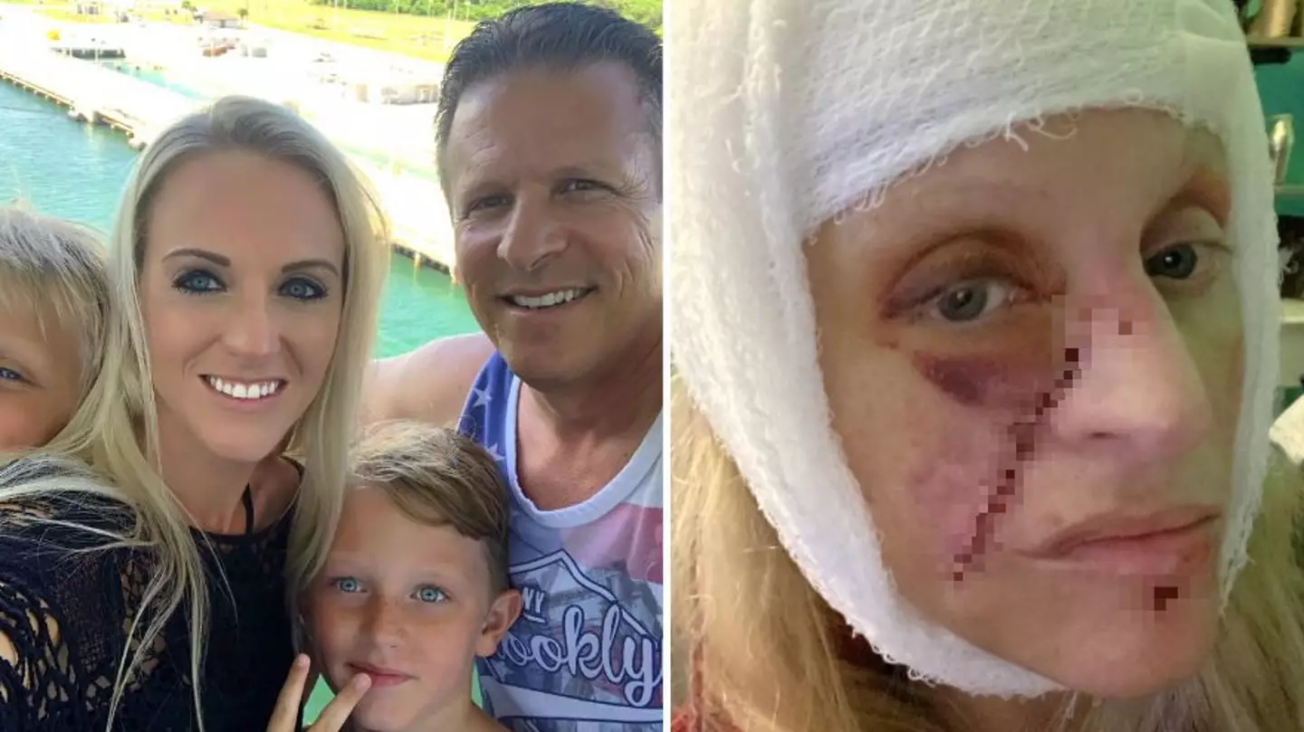 Mum's face 'falls off' after tripping over dog and landing on her nose