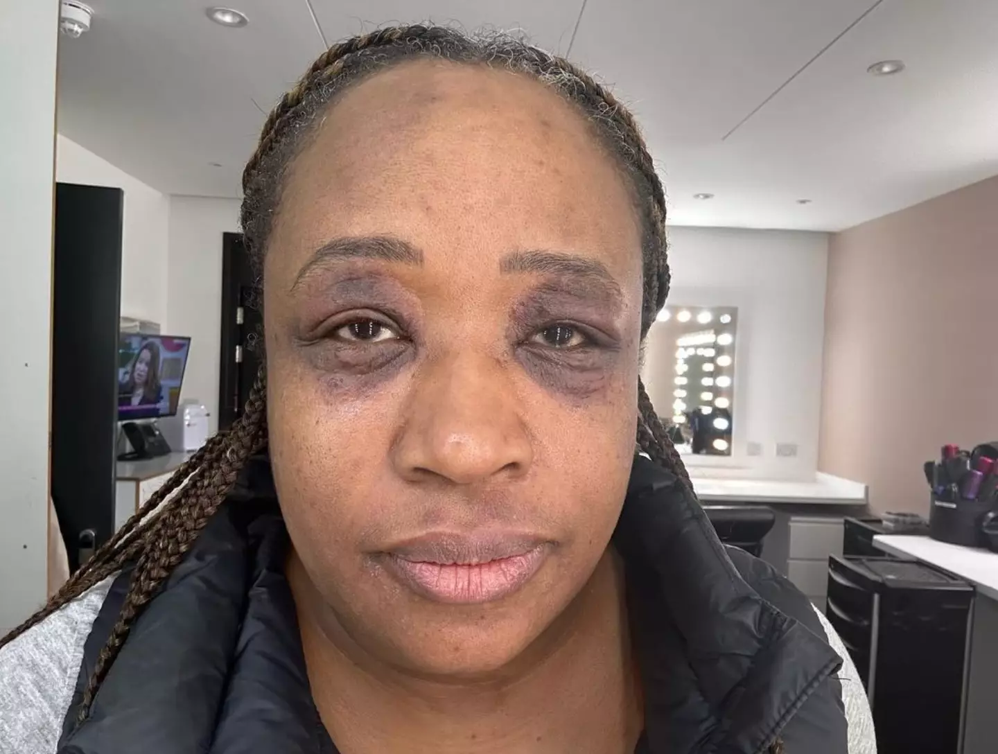 Charlene White showed off the harsh reality of an allergic reaction.