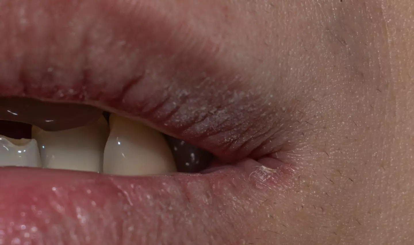 Drooling during sleep and wearing ill-fitting dentures can cause people to develop angular cheilitis (Getty Stock Image)