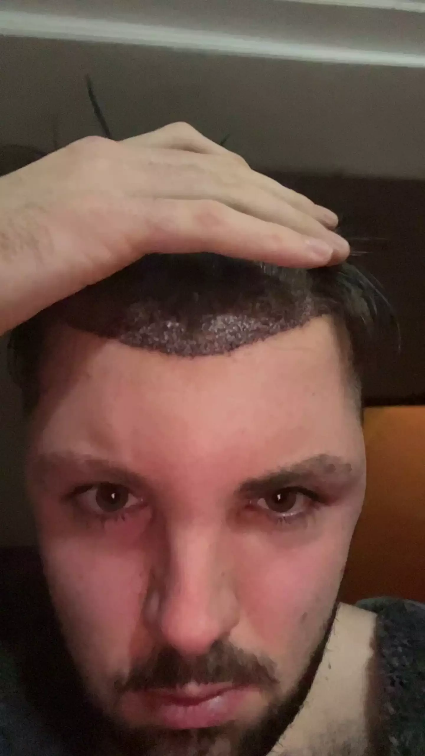 The hair transplant all went well, until he decided not to follow the advice of doctors (SWNS)
