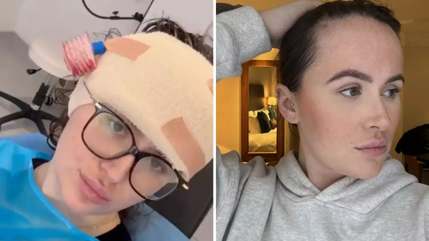 Woman who splashed £9,000 on forehead reduction reveals real reason why she had surgery