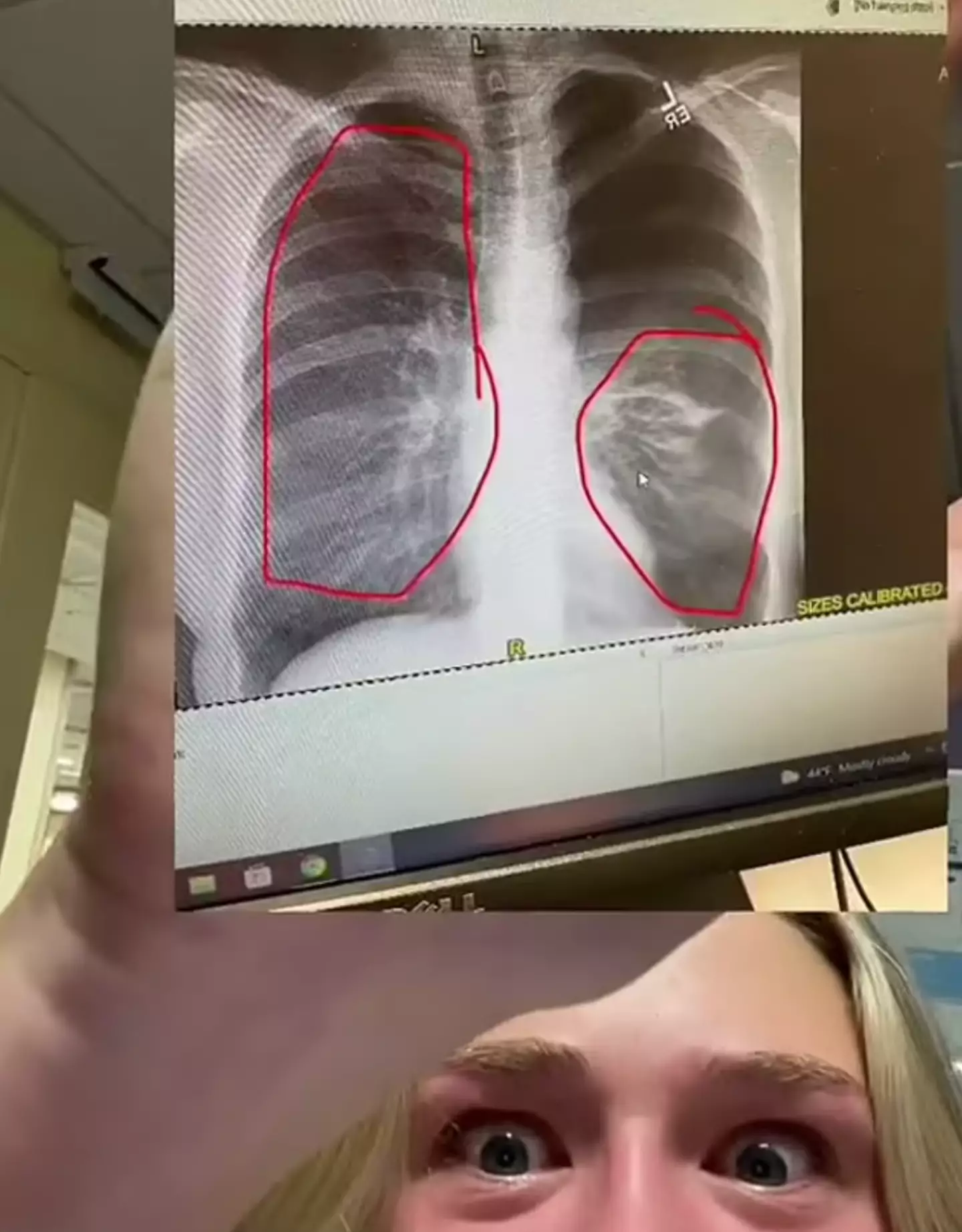 Vaping contributed to this collapsed lung.