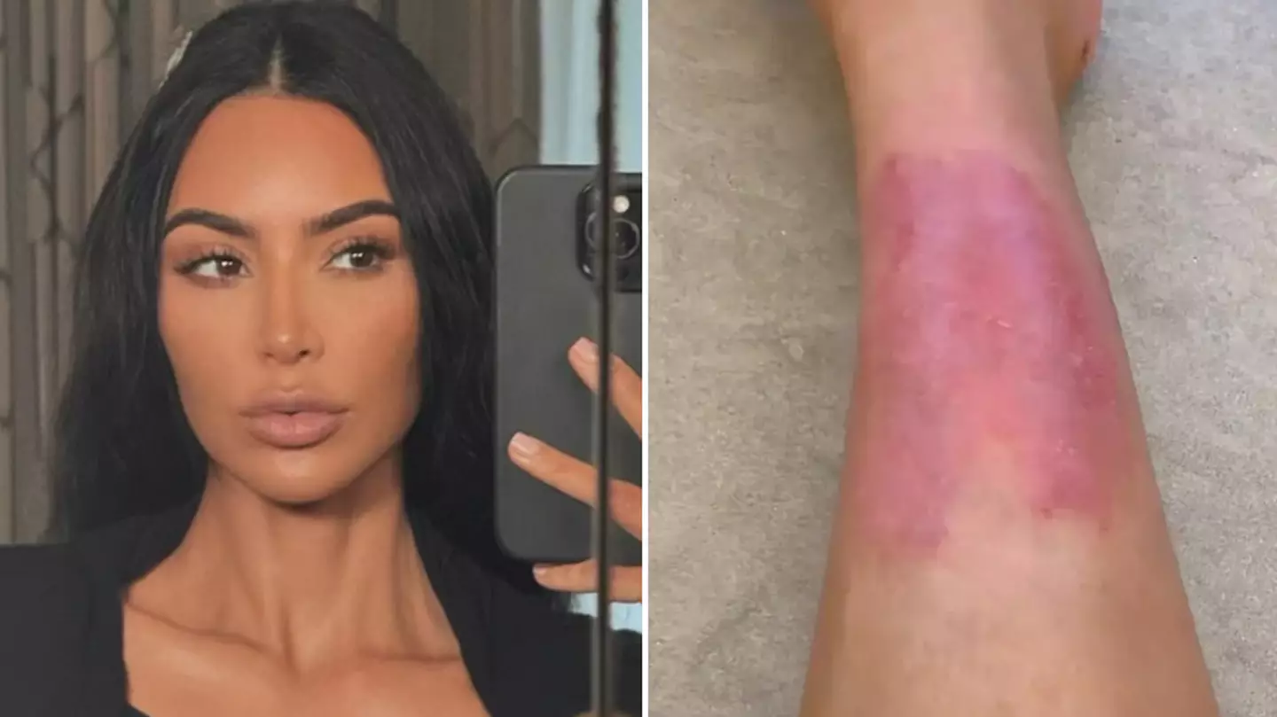 Kim Kardashian sparks concern as she shares 'painful' reality of psoriasis flareup