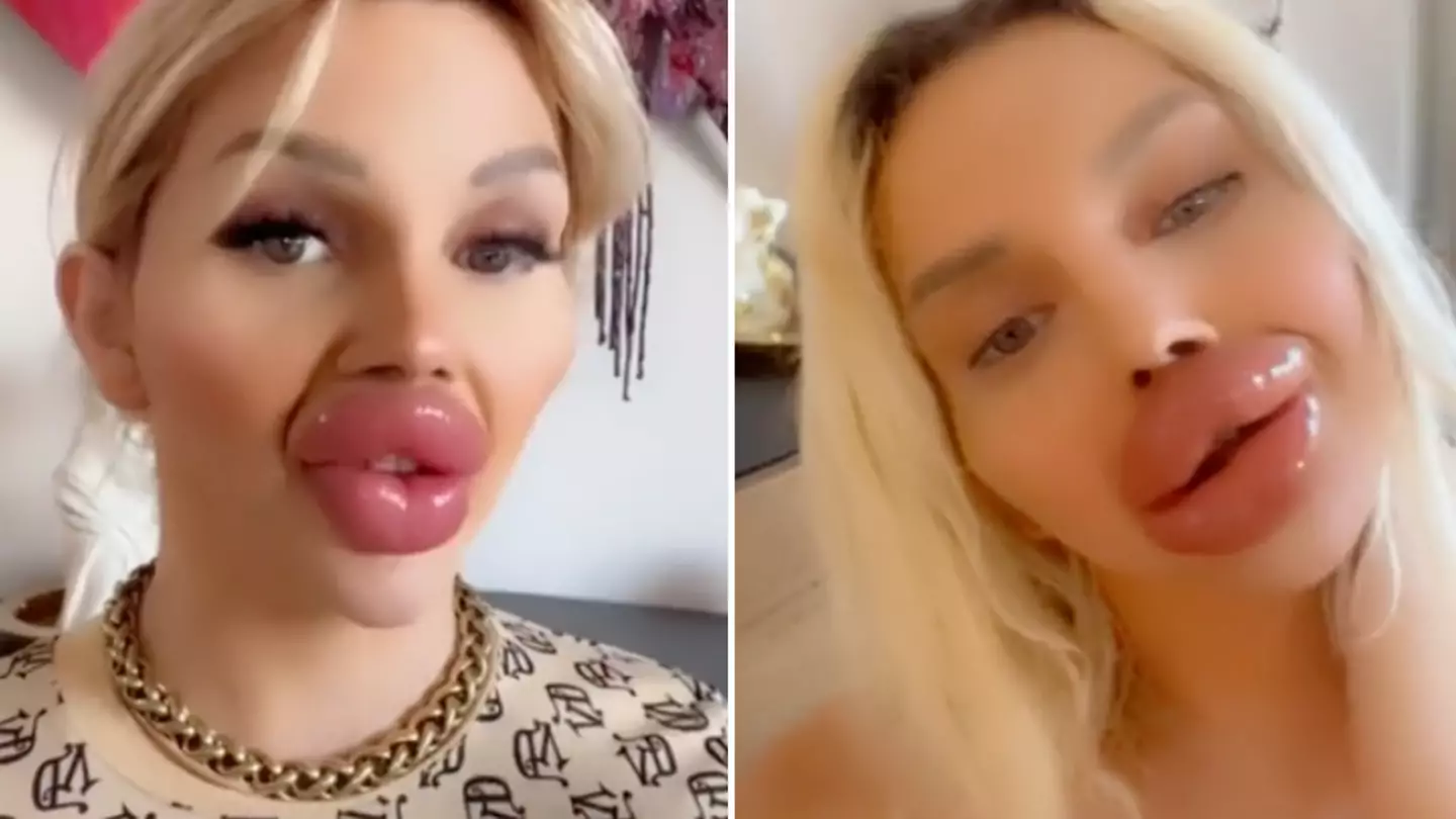 Woman with 30ml of lip filler admits she finds it hard to eat and drink