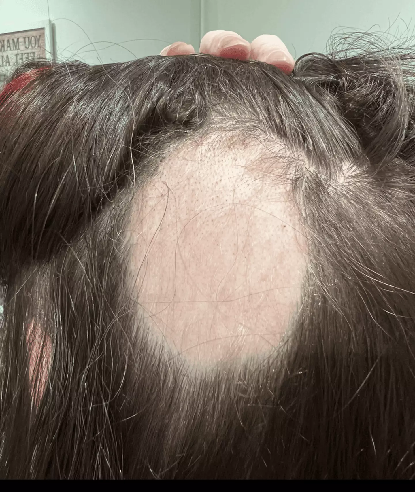 Jen started losing her hair in 2024 (Jen Thomas)