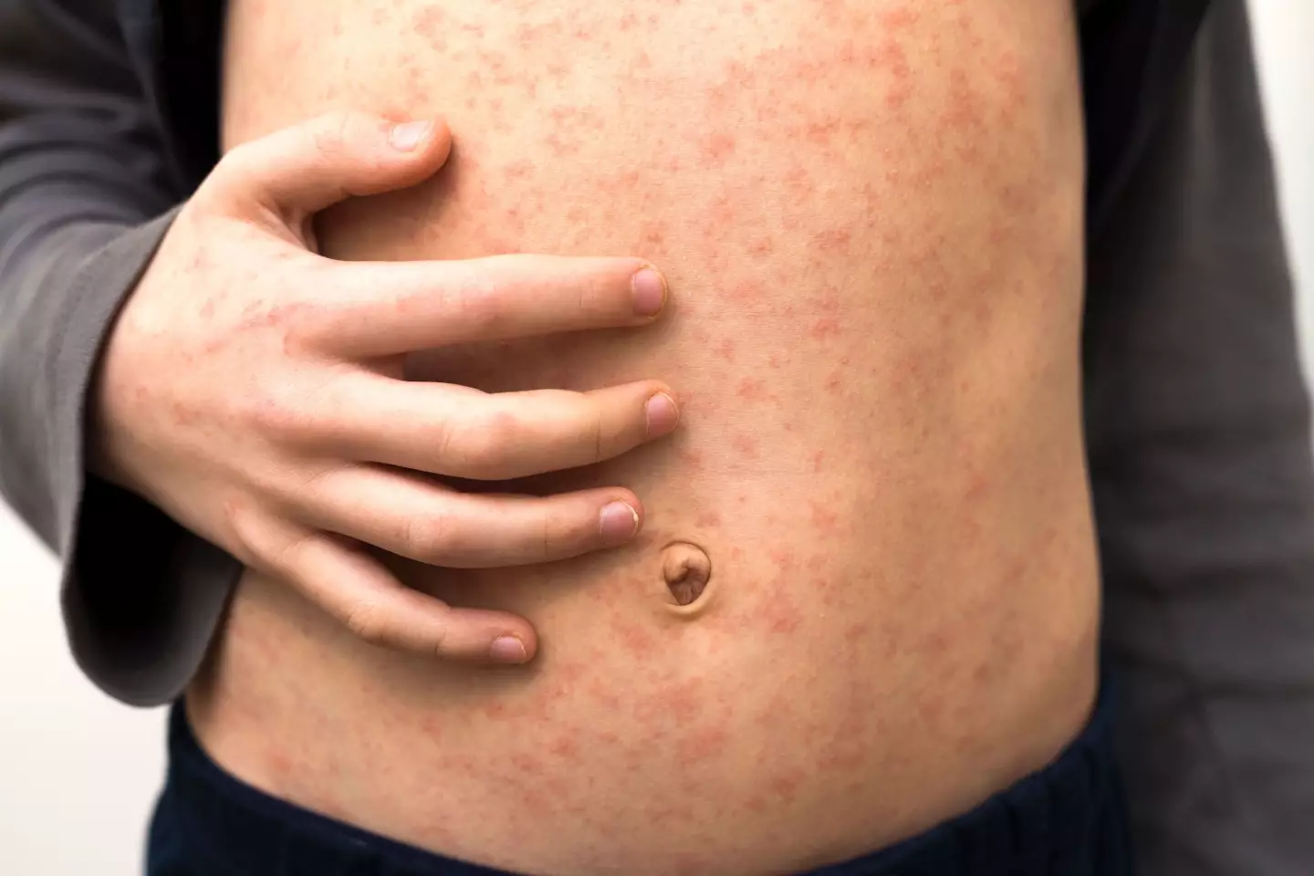 Little Margot had 'awful' symptoms as the rash spread across her body (iStock / Getty Images Plus)