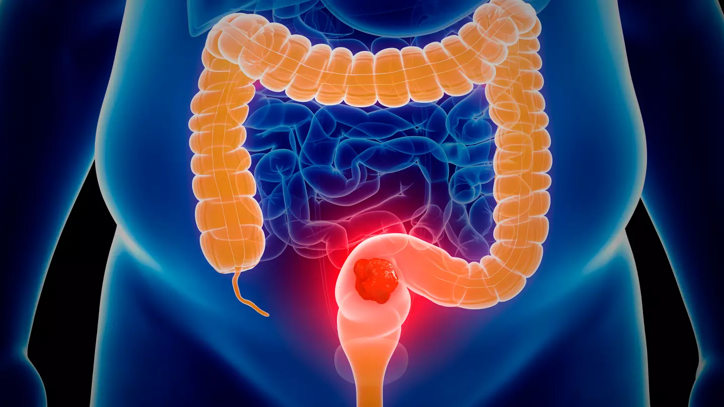 Man only experienced one symptom before getting colon cancer diagnosis