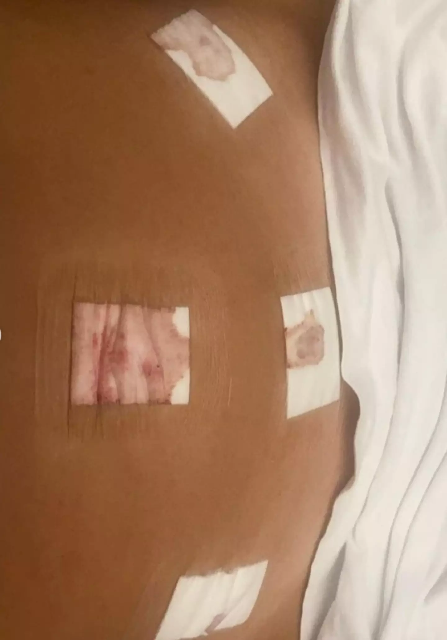 The Scotland-based woman had a laparoscopy a few months ago to diagnose her with the condition.