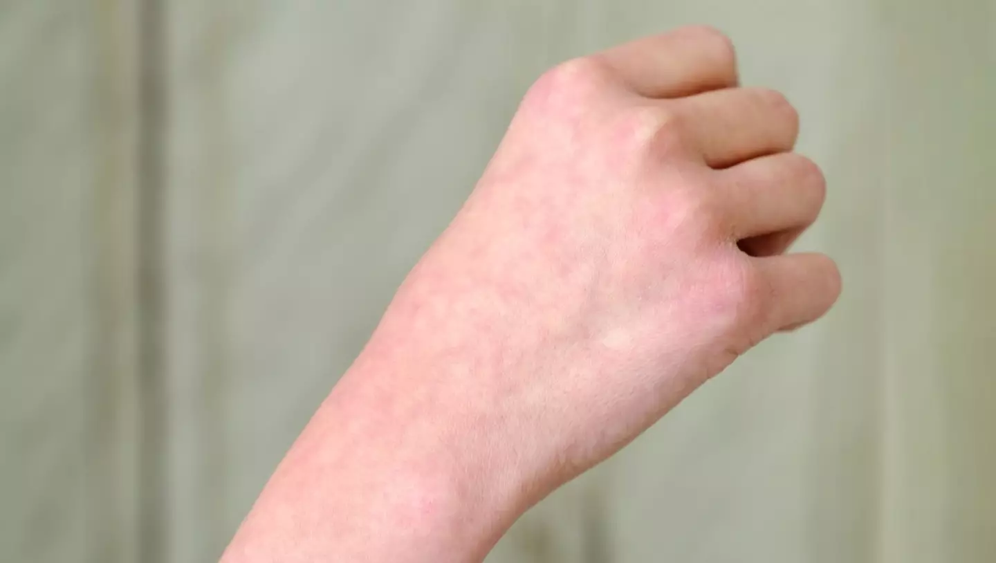 The discolouration is usually harmless and painless, according to experts (Getty Stock Image)