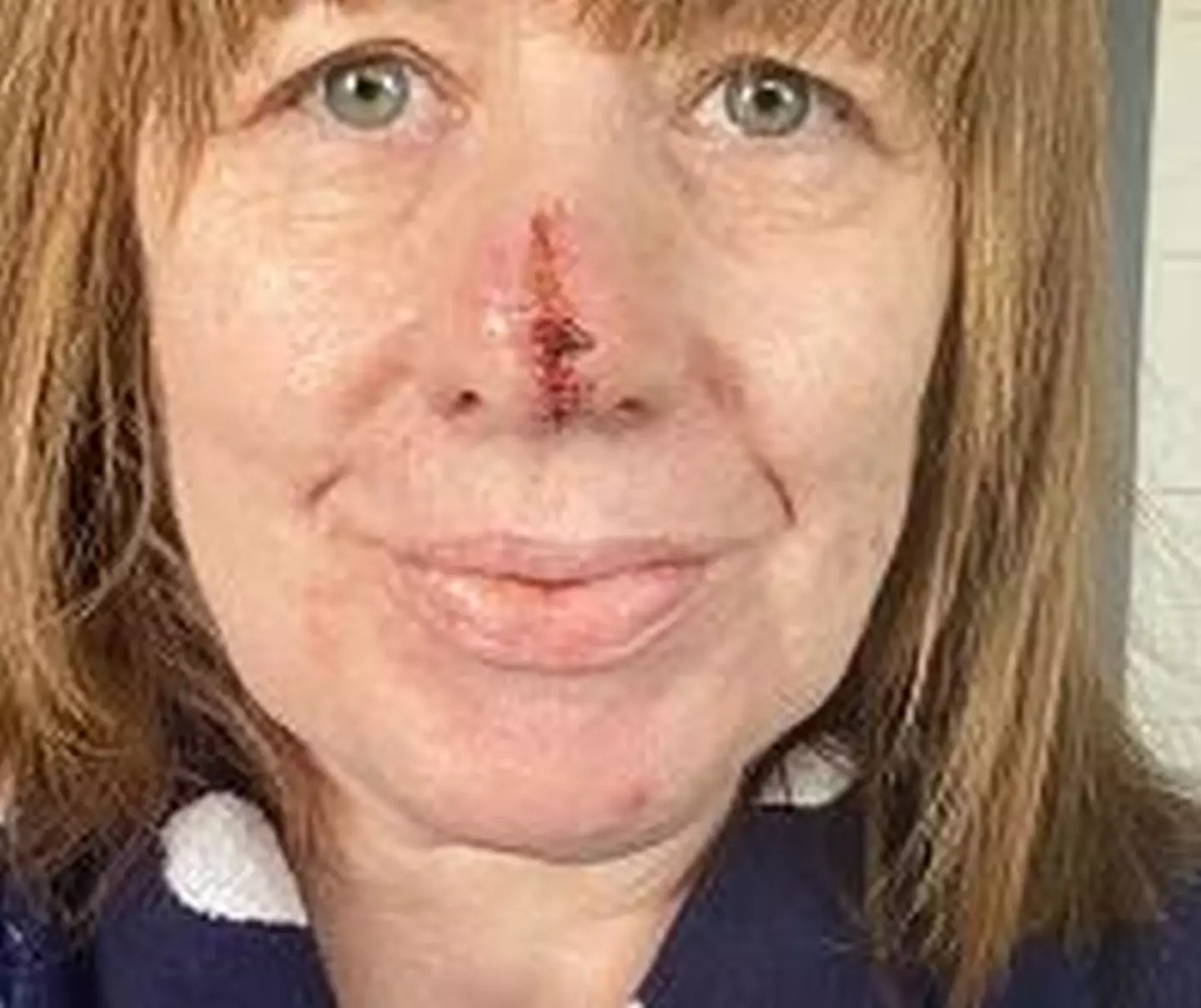 Sarah had a three centimetre chunk of her nose removed.