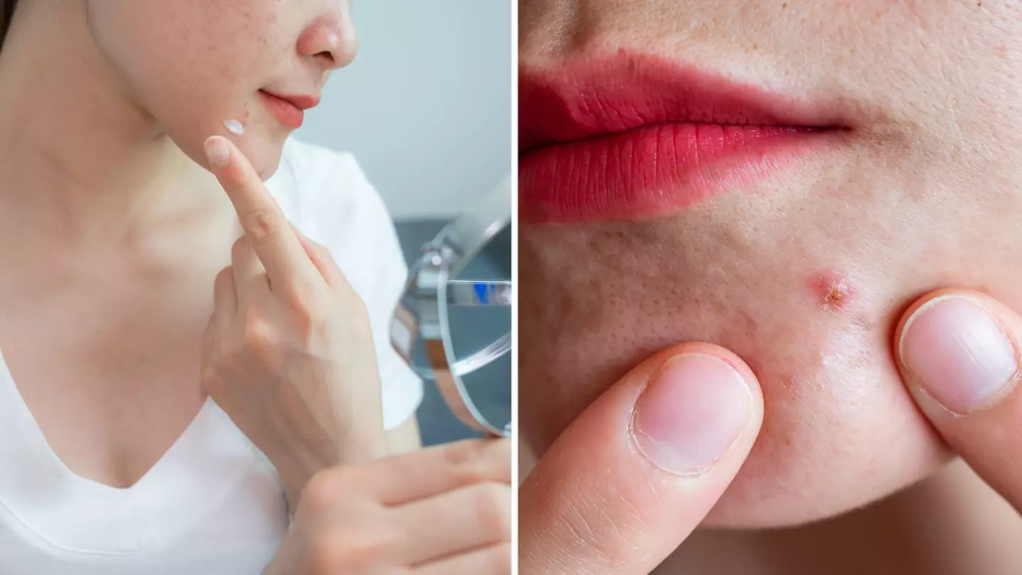 Reason why you keep getting spots on your chin as doctor explains difference to other body parts