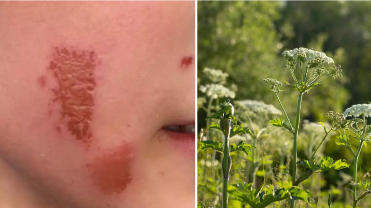 Mum's Warning After Dangerous Plant Leaves Son With Severe Burns