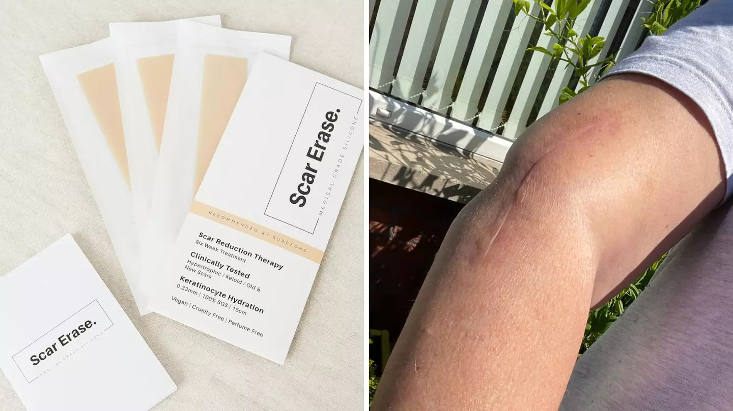 People are 'thrilled with results' of budget scar strips that work 'like magic'