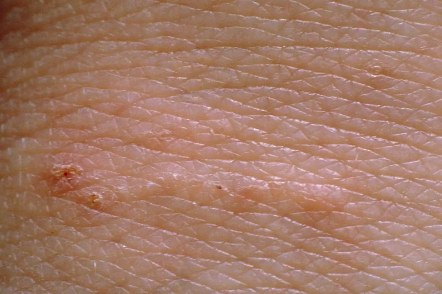 Tiny mites lay eggs in the skin, leaving lines with a dot at one end (NHS)
