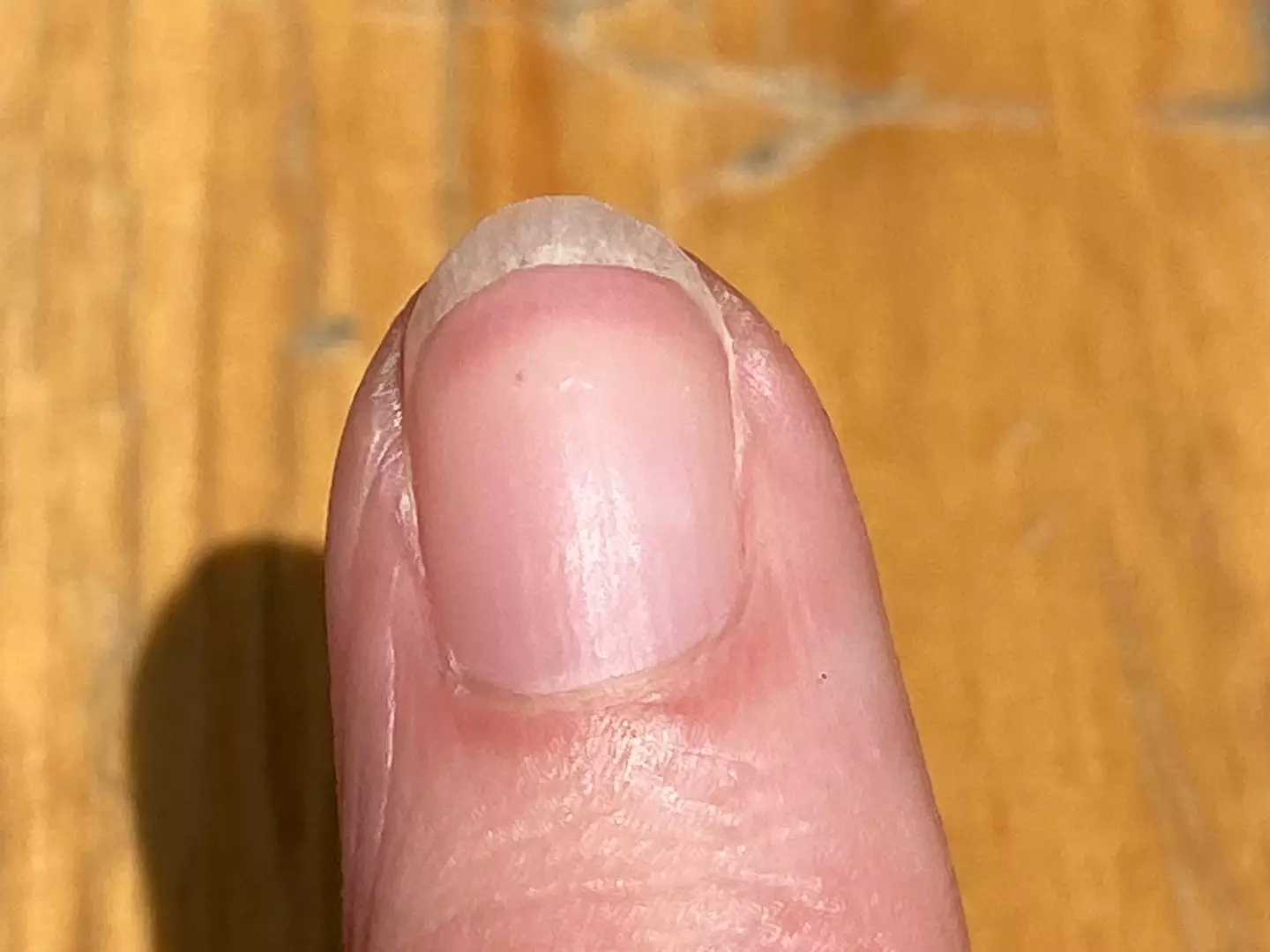 Terry's Nail is when your nailbed is mostly white (Getty Stock Images/ cheekylorns)