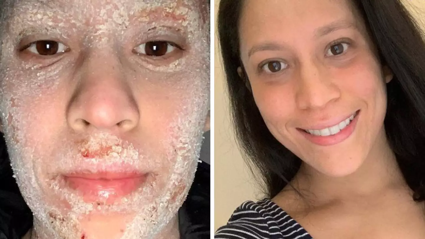 Woman Documents Withdrawal From Steroid Creams After 20 Years