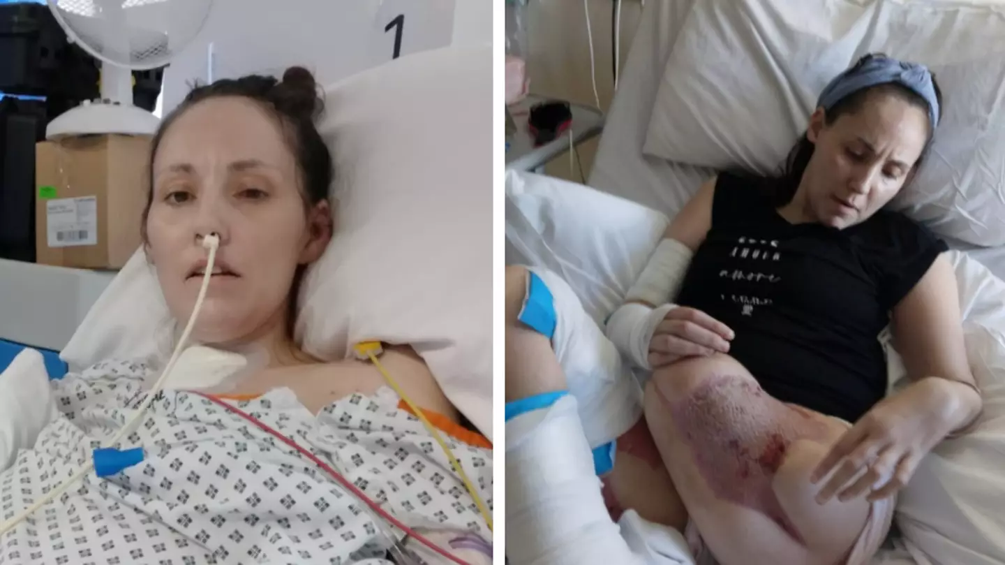 Woman forced to have leg amputated after becoming infected by rare ‘flesh eating’ bug