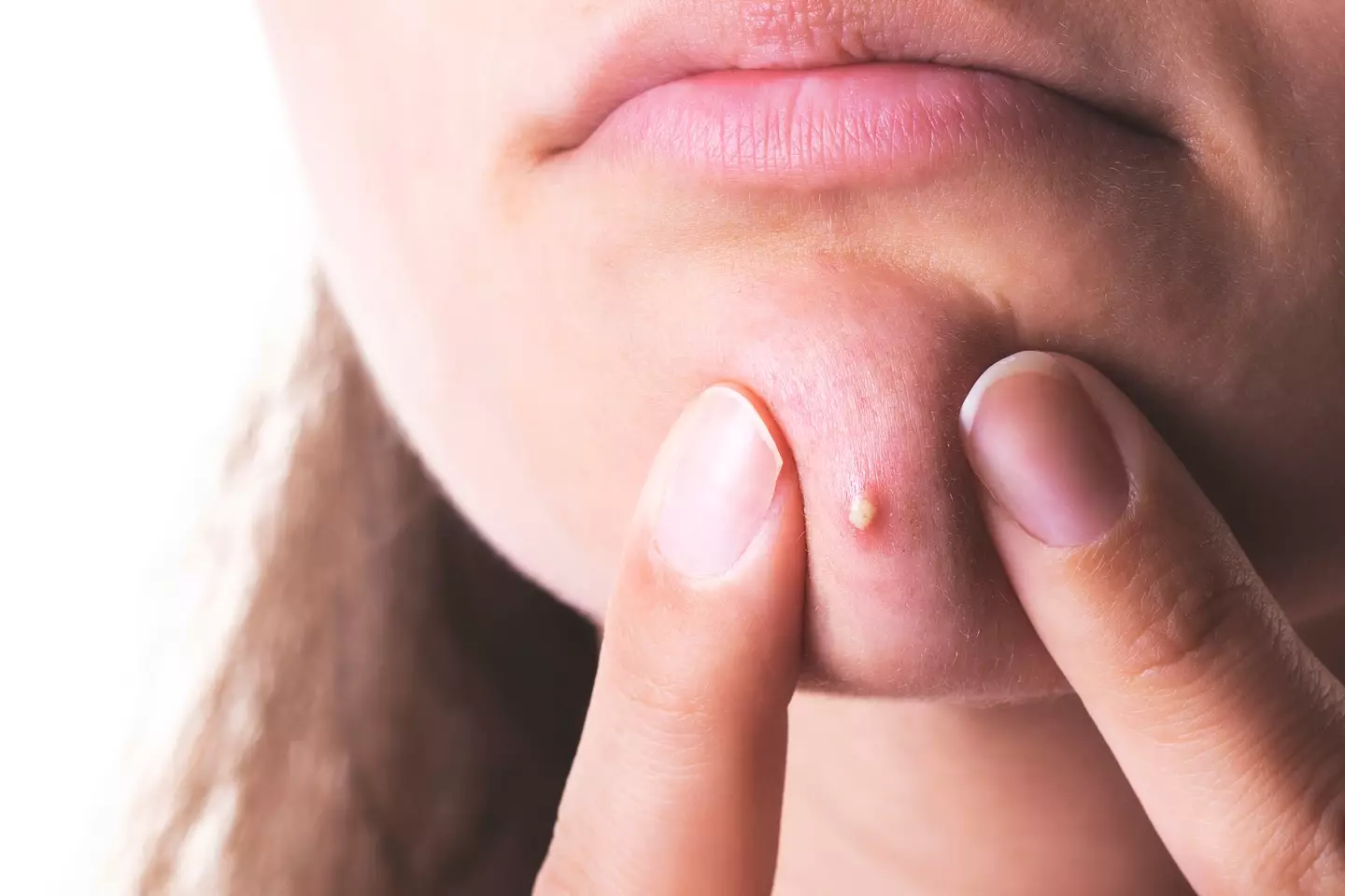 A dermatologist has warned where on your face you should avoid popping spots (Xesai / Getty Images)