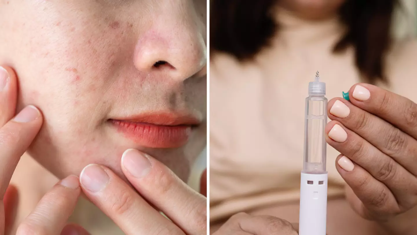 ‘Ozempic face’ explained as common side effect can cause major changes
