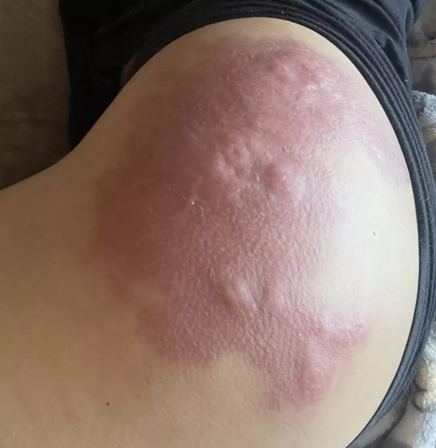 Non-dissolvable silicone was used instead of hyaluronic acid.