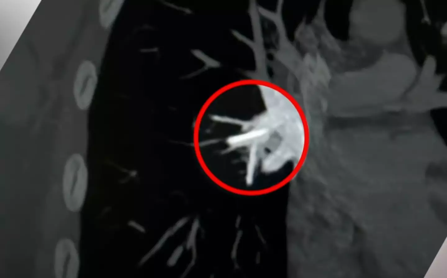 Two years ago, the now 22-year-old from Melbourne went to her local health clinic to have a common birth control procedure, in which a 4cm plastic contraceptive implant rod (Implanon) was put in to her arm.