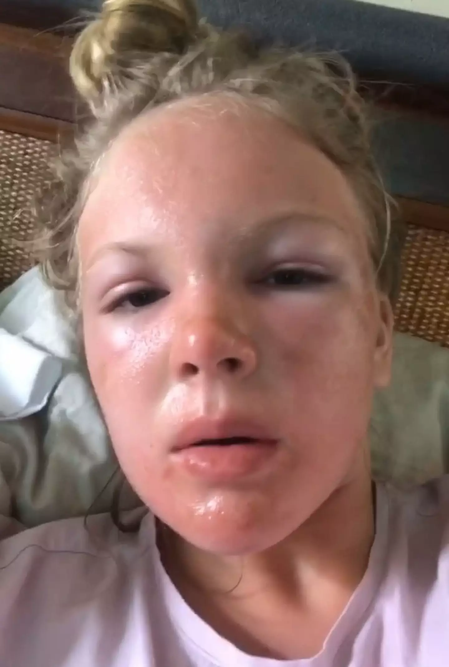 She now warns everyone to wear sun cream even if it's cloudy.