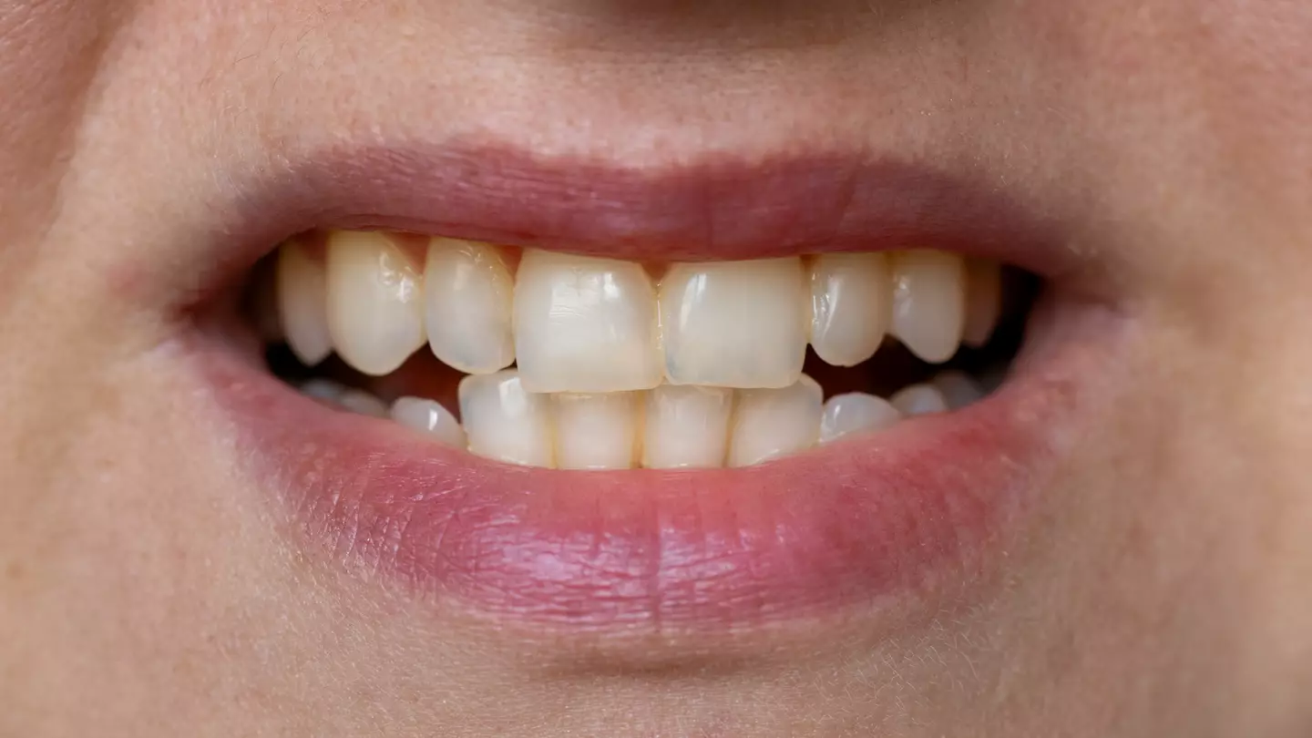 Warning issued to anyone who notices their teeth ‘going see-through’