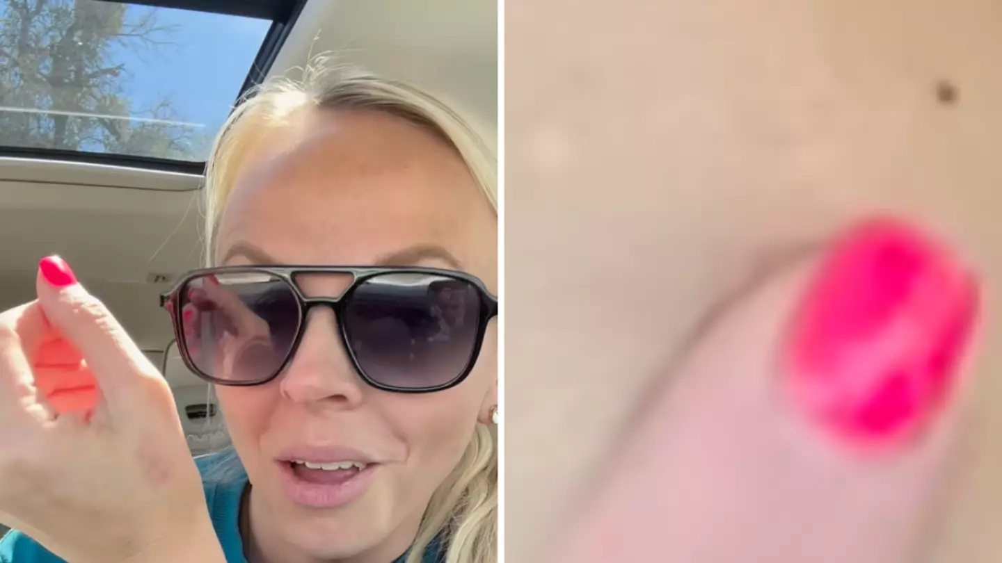 People shocked after realising they have ‘the Millennial mole’