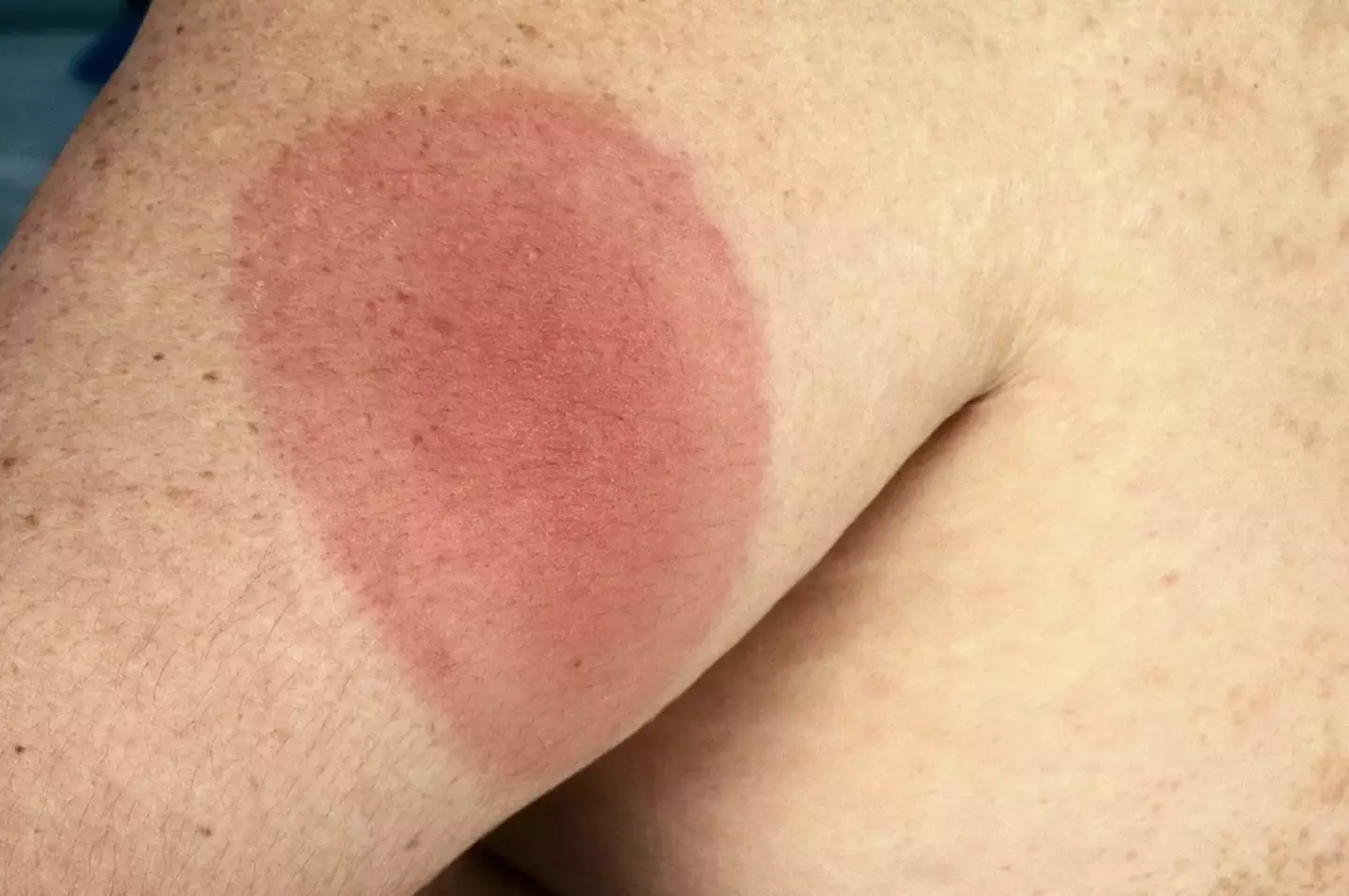 What are the symptoms of this disease? (NHS)
