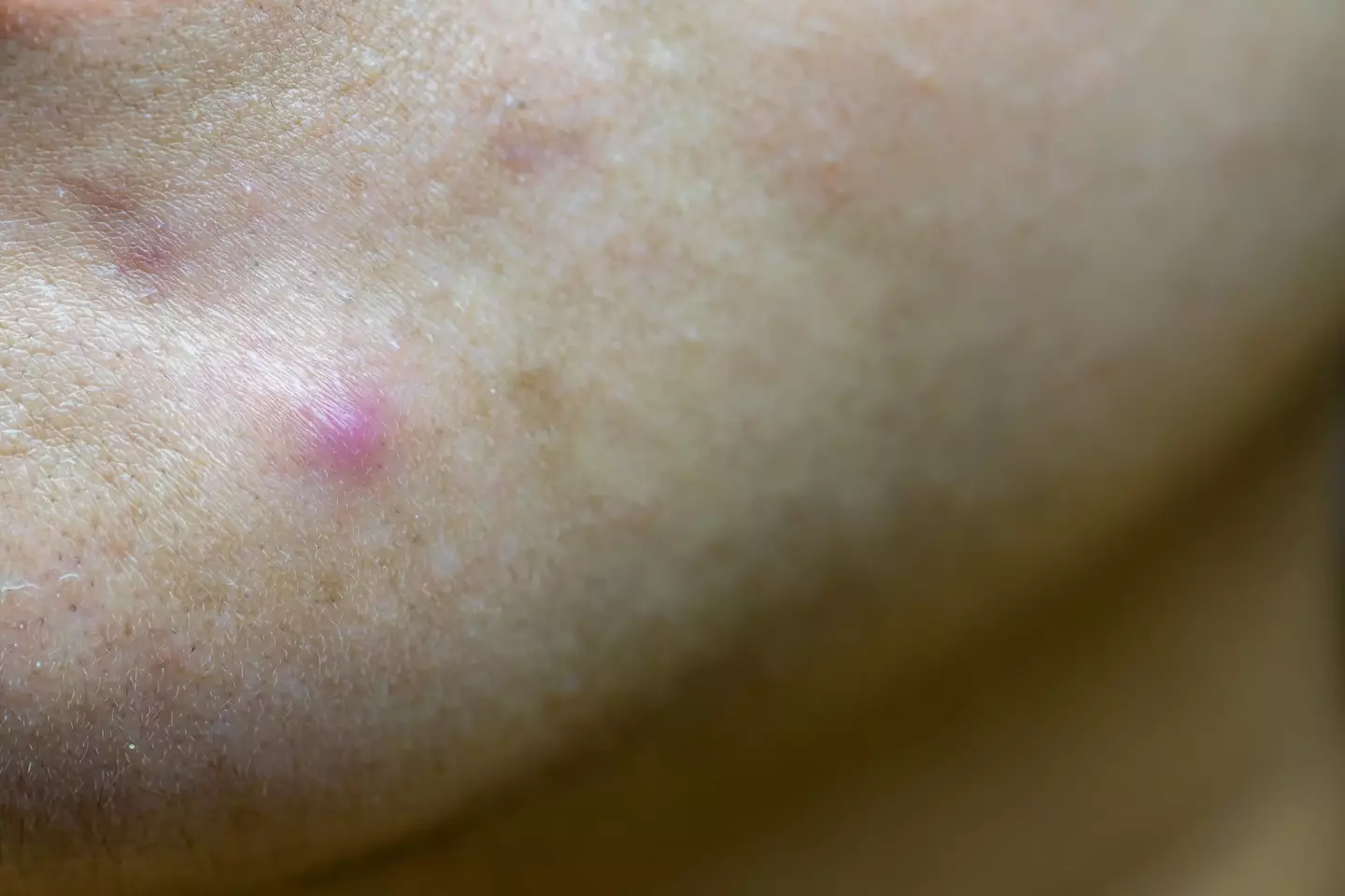 Cystic spots should be treated as opposed to squeezed.