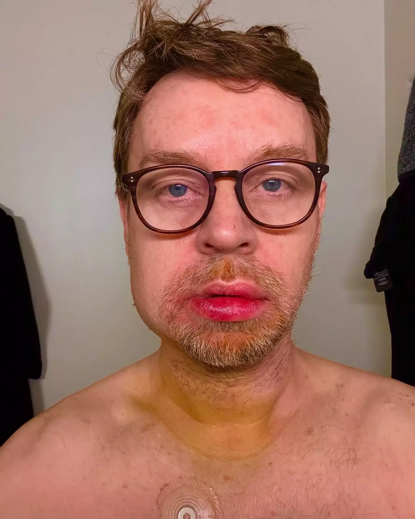 The Savage Garden star opened up about breaking his jaw on social media last Friday (Instagram/@darrenhayes)