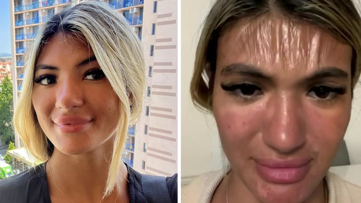 Woman who fell asleep in the sun horrified when she woke up and saw her forehead