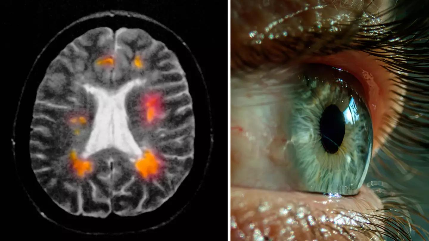 Early sign of MS to look out for that could appear in your eyes