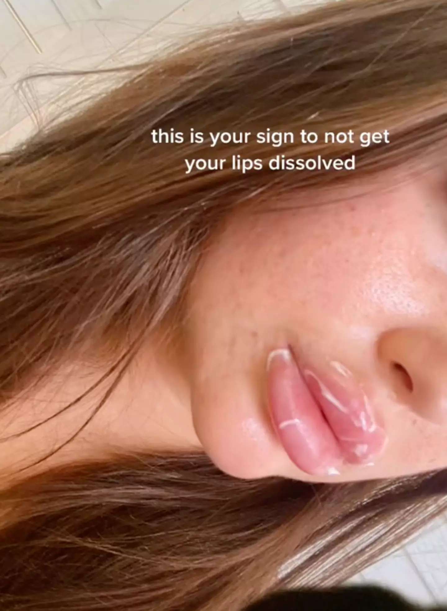 Karli had a reaction to her fillers being dissolved.