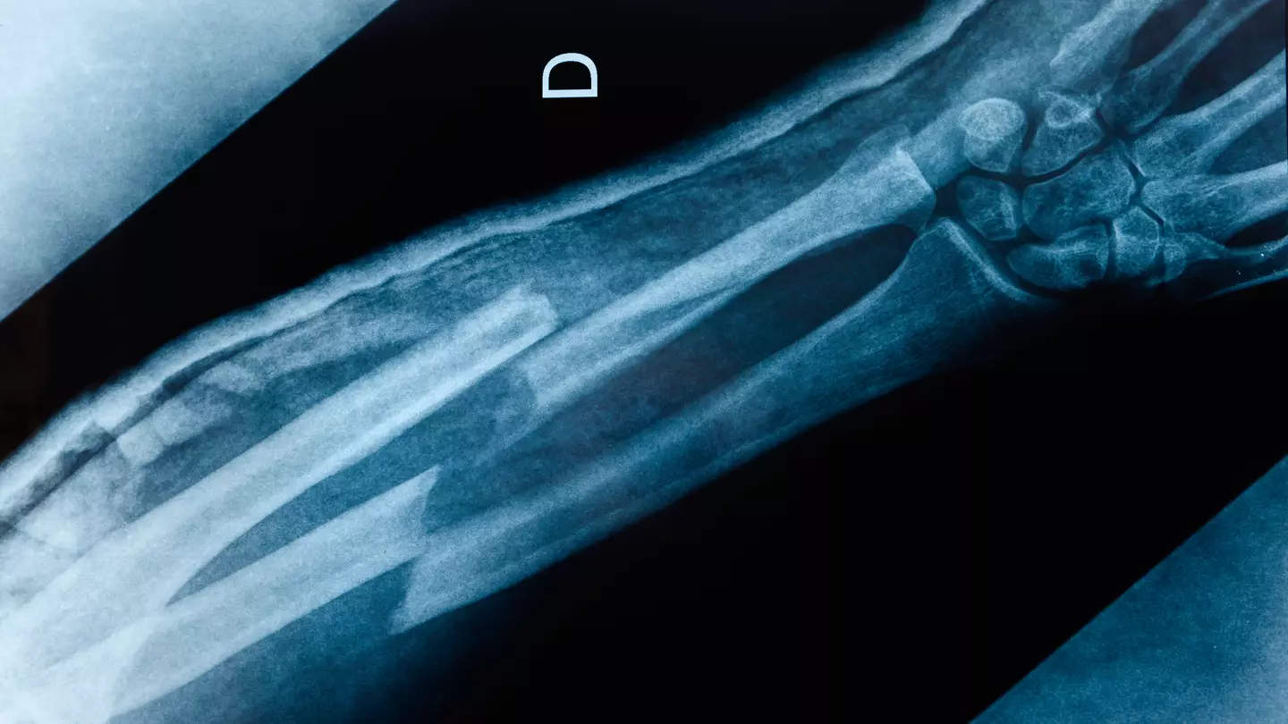 Bizarre exclusive community you can only join if you’ve never broken a bone as eerie conspiracy theory goes viral