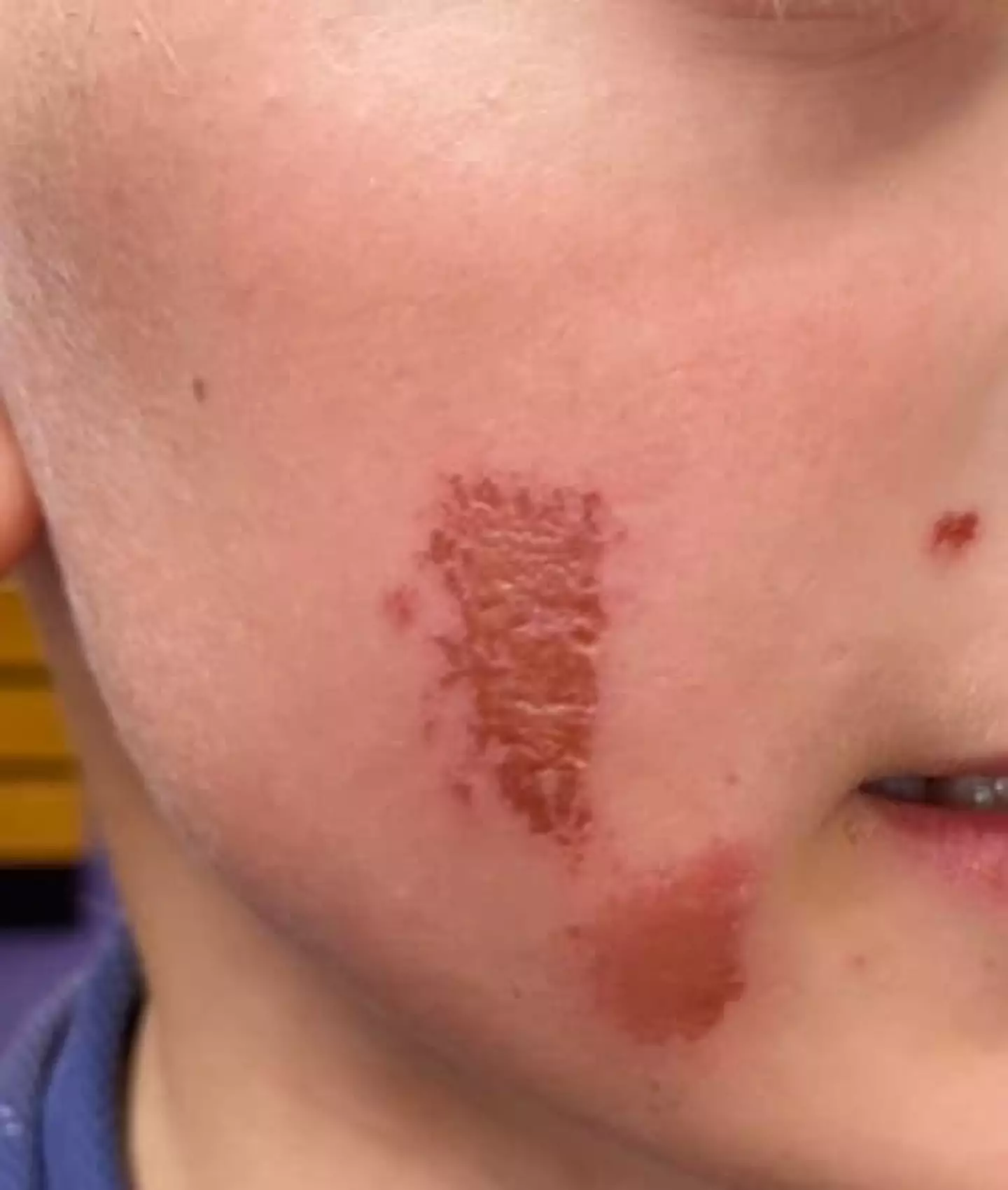 One mum was left horrified when her son developed burns on his skin. (