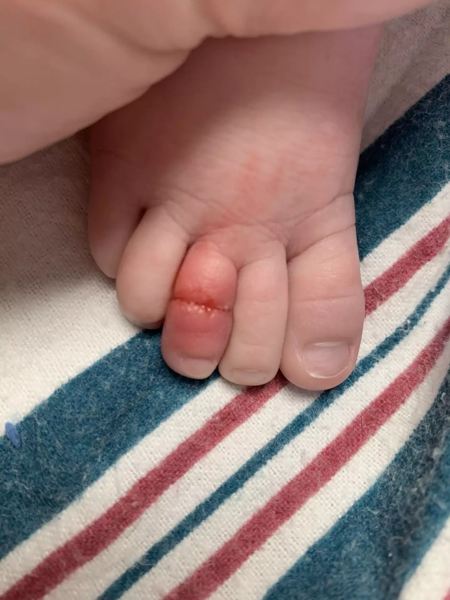 Logan's toe started to swell and become red (