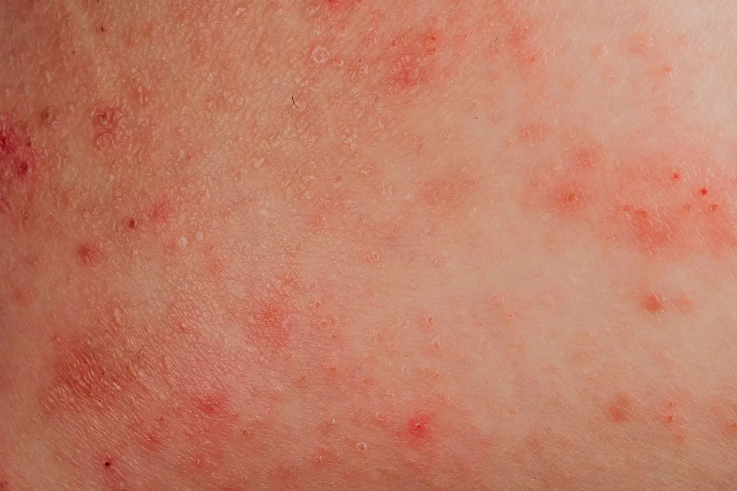Contact dermatitis often occurs due to contact with certain products (Getty Stock Image)