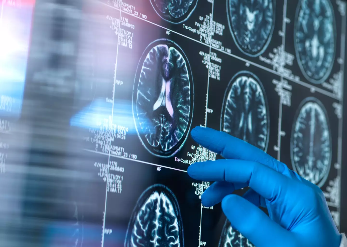 This can be one of the first signs (Getty stock photo)