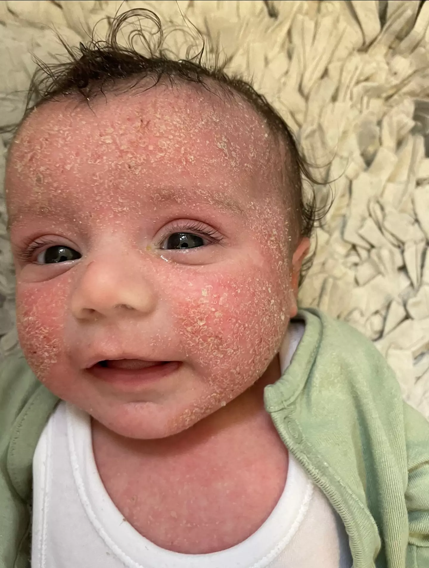 One mum was distraught after her three-month-old daughter developed severe eczema.