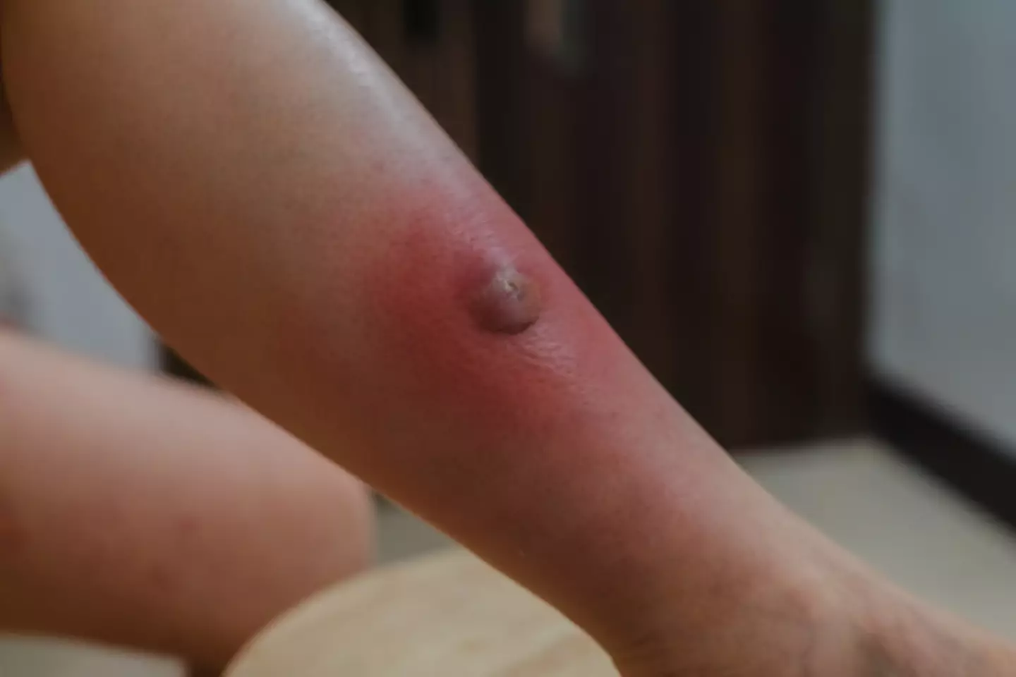 Folliculitis can be dangerous (Getty Stock Images)