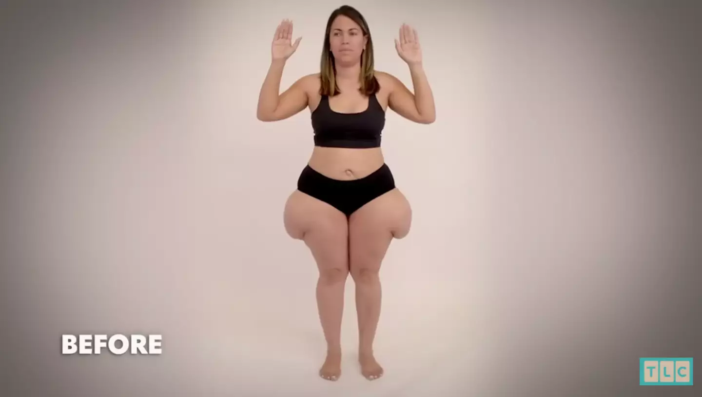 Rubi first noticed a change to her hips and thighs after going through her fourth pregnancy.