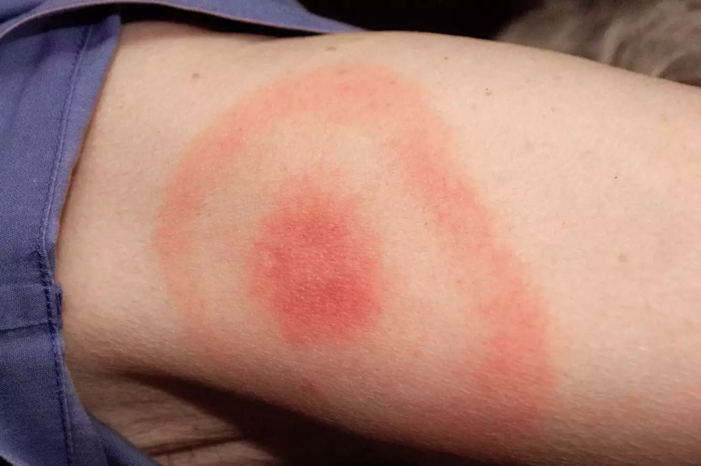 One of the main early Lyme disease symptoms is a 'circular or oval shape rash' forming around a tick bite (NHS)